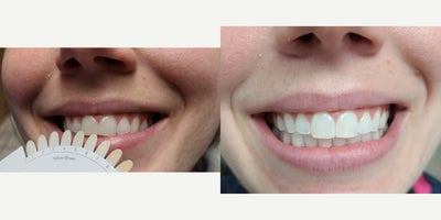 25-34 year old woman treated with Zoom Whitening - Zoom teeth whitening in office, completed in 1 hour. Results: 4 shades lighter.