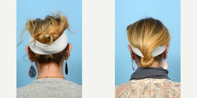 35-44 year old woman treated with Earfold - otoplasty