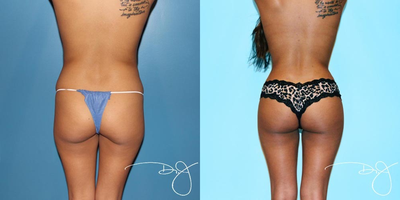 Buttock Augmentation  - 
	This patient had liposuction and contouring of the flanks, upper and lower abdomen, upper and lower back and inner thighs with a fat transfer to the buttock. Photo is 3 months post-op.
