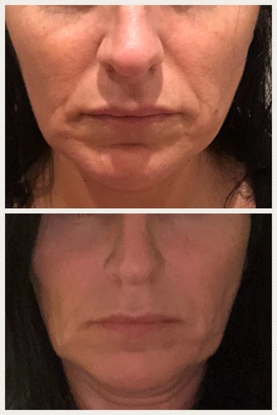 46 Years Old Done Ultherapy Treatment London Review Realself