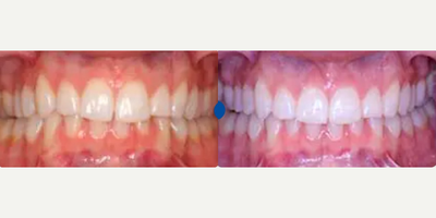Woman treated with Invisalign, Smile Makeover - Patient presented with a chief complaint of his upper front tooth sticking out. Invisalign treatment took just months to complete followed by Zoom! white speed in-office whitening to give a brighter smile.