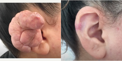 25-34 year old woman treated with Scar Removal - 25-34 year old female patient came into the office presenting with a growing keloid on the helix of her ear. She was treated with surgical removal of the keloid, along with triamcinolone injections following suture removal to ensure that the keloid did not return.