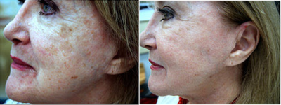 Fractional C02 laser - 
	treated with deep Fractional CO2 laser for photodamage and acne scarring.&nbsp;
