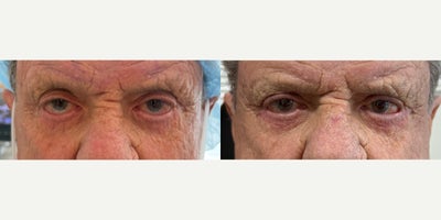 75 and up year old man treated with Eyelid Surgery, Canthoplasty - 7 weeks s/p lateral canthoplasty with full thickness skin graft placement in lower eyelids