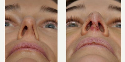 35-44 year old woman treated with Rhinoplasty, Septoplasty - Day 7 photos - 1-week post-operative photos showing mild bruisingThe profile photo also shows the computerized preoperative plan, then the actual post-op photo