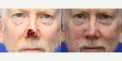 64 year old man treated with reconstruction after Mohs Surgery for skin cancer - This gentleman had a basal cell cancer resected by Mohs surgery. He is now 6 months out from a reconstruction of his nasal tip with a nasolabial flap.