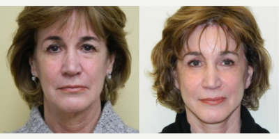 45-54 year old woman treated with Brow Lift - Mini Facelift, Browlift, Upper, and Lower Blepharoplasty
