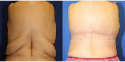 35-44 year old woman treated with Back Lift - This patient in her mid-40s was unhappy with her back rolls after losing 200 pounds. She desired a flat back. The doctor was able to remove excess skin and fat of her back by performing an upper body lift (also known as a torsoplasty).
