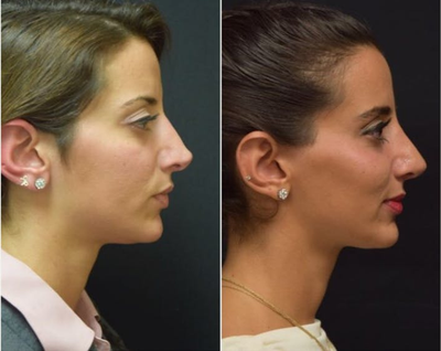 Woman treated with Laser Hair Removal - Woman treated with Laser Hair Removal