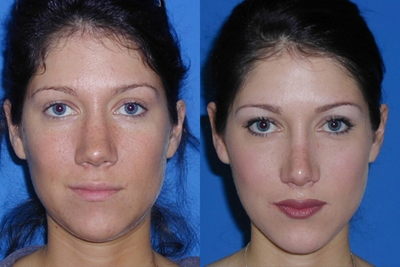 Rhinoplasty - Rhinoplasty
