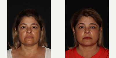 55-64 year old woman treated with Facelift, Eyelid Surgery, Laser Resurfacing, Facial Fat Transfer, Rhinoplasty - MD Restore, Deep-Plane (Additional Procedures: Eyelids, Laser Resurfacing, Fat Transfer, Rhinoplasty)