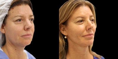 Woman treated with Chin Implant, Facelift, Neck Lift, Liposuction - Chin Implant, Facelift/Neck Lift, Liposuction