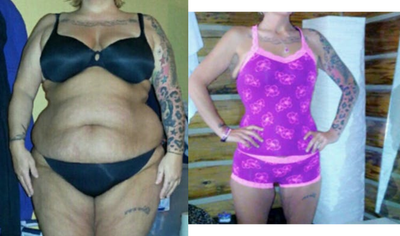 Sleeve Gastrectomy - Gastric sleeve procedure. Surgery performed by Dr Alejandro Lopez