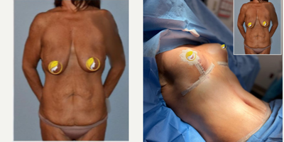 55-64 year old woman treated with Breast Lift, Liposuction, Tummy Tuck, Breast Reconstruction with Fat Transfer - MASSIVE WEIGHT LOSSThis patient did a great job losing weight and getting healthy. Unfortunately she was left with very loose skin and sagging breasts..SURGERY PERFORMED:Breast lift (hybrid)Galaflex mesh scaffold internal braFat transfer to breastsTummy tuck with liposuction