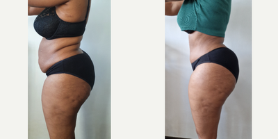 45-54 year old woman treated with Tummy Tuck, Liposuction, Liposculpture, Mommy Makeover - OP: LIPO 360 (2.5kg) and Tummy tuck (900g). 2 hour op. Recovery took 2 weeks. All swelling gone by 6 weeks to 3 months (after pic was taken 6 month later).