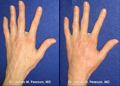 Hand Rejuvenation - 
	Hand Rejuvenation
