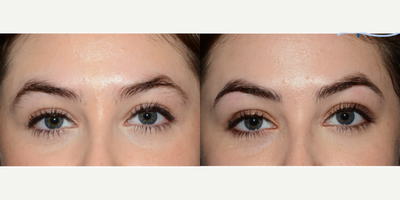 18-24 year old woman treated with Microblading - Microblading treatment of the eyebrows.