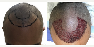 25-34 year old man treated with Rogaine - This is a 29-year-old male patient who came to us with a 4-year history of hair loss, with a significant recession of his frontal and temporal (side) hairlines. This resulted in the appearance of deep recessions that, even before age 30, were extending well behind his ears.Hed already started finasteride about a year before his surgery and noticed that his hair loss had stopped. He had no side effects from this medication.We did an 1800 graft FUE procedure to advance his frontal hairline only, which effectively brings it down along the sides to improve the deep recessions. He didnt want to bring the temporal (side) hairlines forward just in case he had future recession in that area behind the transplanted hair. His result (shown at 1-year post-op)! Even though we only advance the frontal hairline by about 1cm (as seen on the surgical markings), you can see from the photo markings that his hairline was brought significantly closer to his eyes, and the frontal-temporal points are now well ahead of his ears, instead of behind them. The overall result is very natural and very masculine looking, and is sure to continue to be well into the decades ahead. Immediately following his surgery he was also started on high-strength topical minoxidil to further enhance his surgical result, and this patient is continuing on that combination of finasteride and minoxidil to keep his hair looking great for decades to come.