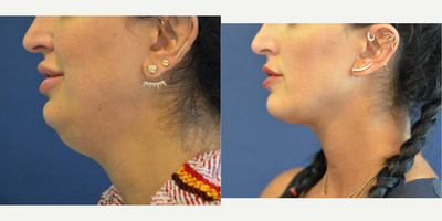 Female treated with CoolSculpting - Before and after CoolMini. Non-surgical contouring of the neck.