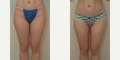 25-34 year old woman treated with Liposuction - liposuction inner thighs