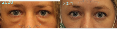 woman after lower blepharoplasty - eye bag removal via transconjunctival approach