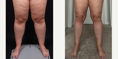25-34 year old woman treated with Lipedema Liposuction Surgery - This lovely patient faced a lifetime of being told she needed diet and exercise to address her weight.Despite losing 30 lbs with hard work and dedication, the appearance and discomfort in her arms and legs persisted.After seeking treatment from Dr. Aria, shes now living her happiest life, feeling lighter, and enjoying her favorite activities like spin classes without knee pain!
