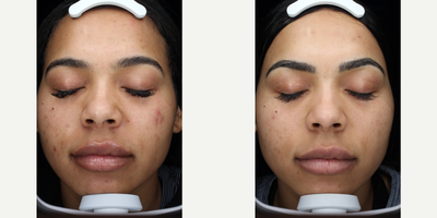 18-24 year old woman treated with Clear and Brilliant - This patient did a series of 3 Clear and Brilliant treatments combined with proper skin care and LED light therapy.