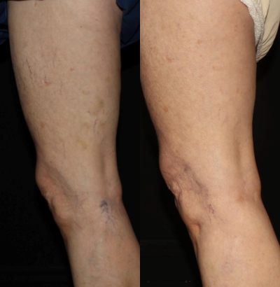 35-44 year old woman treated with Asclera - Results after two sessions of Asclera to spider veins on legs.