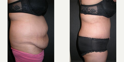Woman treated with Tummy Tuck - This young mother was unhappy with the large rolls on her tummy, with excess skin and fat. An abominoplasty (tummy tuck) flattened her tummy and improved her shape dramatically.