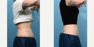 25-34 year old woman treated with Cryolipolysis - Looking for overall reduction of fat around her mid-section, this 27-year-old patient was treated with 2 CoolSculpting sessions for the lower abdomen and flanks, and 1 session for the upper abdomen. She is thrilled with the results.