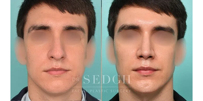 25-34 year old man treated with Rhinoplasty, Chin Implant, FaceTite - Lets call it trifecta! These final results are a combination of a Male Rhinoplasty, Chin Augmentation, and Facetite. All three procedures have created structure, definition, and depth for our patient's overall appearance.