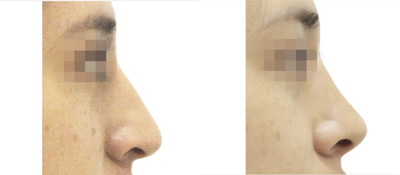 25-34 year old woman treated with Rhinoplasty - It is important to determine together with the patient the desired effect. I perform all nose surgeries with a closed technique. This is why the patient does not have a incision mark in the area below the nose. Through this approach, I correct the projection of the tip, the dorsum and the nasal base. I always work with an otolaryngologist who is in charge of the functional component and manages the septum and turbinates. The aesthetic part is done by me.
