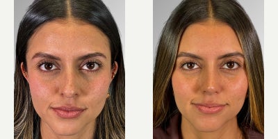 25-34 year old woman treated with Facial - Our patient came in seeking a harmonious and natural transformation. She presented with a dorsal hump, a long nasal tip, and asymmetrical nostrils. We performed an ultrasonic rhinoplasty to refine and balance every detail of her nose, and complemented the result with facial fat grafting, achieving a more beautiful, refreshed, and perfectly harmonious look with her facial features. We complemented the procedure with CO2 laser to improve the quality of the skin.