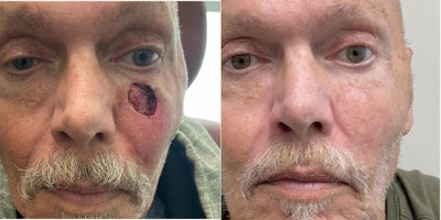 55-64 year old male treated with Mohs Surgery - 55-64 year old male treated with Mohs Surgery by Dr. Bonett at Naples Plastic Surgery.