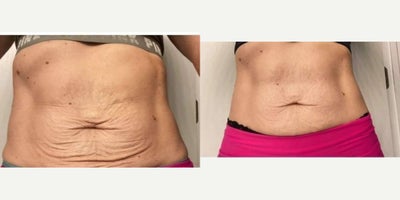 45-54 year old woman treated with Morpheus8 - Morpheus8 Body treated by Alyssa G
