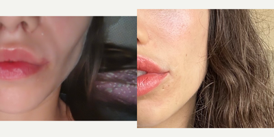 25-34 year old woman treated with Facial Fat Transfer, Renuva - Patient who underwent a fat pad removal (but she wasnt a candidate for that procedure) and was left with a gaunt face that made her look older. Treated with fat transfer + semi permanent fillers
