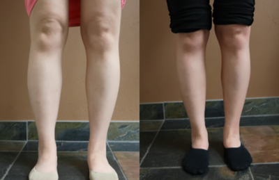 25-34 year old woman treated with Calf Reduction - This patient desired smaller lower legs. Liposuction was performed under local anesthesia (with oral anxiolytics/nitrous oxide gas) with minimal discomfort. The patient will continue to notice reduction in the calf size over the next several months.