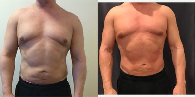 45-54 year old man treated with Emsculpt - EMsculpt of abdomen