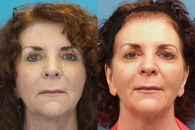 55-64 year old woman treated with Silhouette InstaLift - This patient had 3 Silhouette Instalift sutures in each side of the face (2 in the jaw area on each side and one in the neck on each side).
