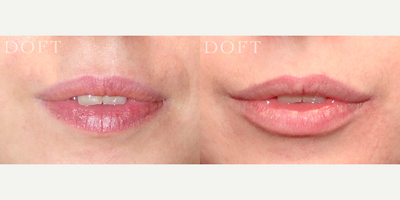 33 year old woman treated with Lip Thread-Lift - This patient achieved beautiful definition and fullness to her lips with the non-surgical in-office procedure of a lip thread-lift. After local anesthetic is applied, slender threads are inserted with a needle into the outer rim of the upper and lower lip, which then adhere to the tissue and increase collagen production, fullness and lip definition. Results improve over several months and last 1-2 years.