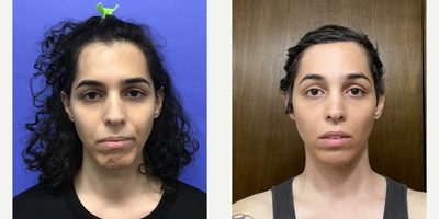 Patient treated with Facial Feminization Surgery, Transgender Facial Feminization Surgery - 25 to 34 year-old female patient is 1 year post-op from Facial Feminization surgery. Her procedures included: Forehead Lift, Hairline Lowering, Orbital Bony Contouring, Septorhinoplasty (closed) with Cartilage Grafts, Chin Implant (central) with Contour and Reduction, 1cc Voluma, Thyroid Cartilage Shave, Soft Tissue to Nasolabial Folds, and 300 Micrografts to Recessions.