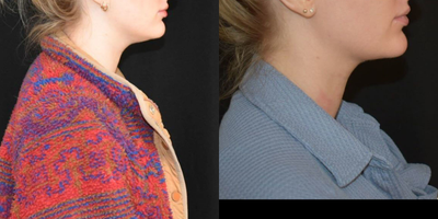 25-34 year old woman treated with Chin Liposuction - These photos show before and after chin liposuction. This is an office-based procedure which takes about 1 hour.