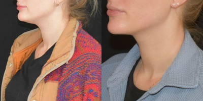 25-34 year old woman treated with Chin Liposuction - These photos show before and after chin liposuction. This is an office-based procedure which takes about 1 hour.