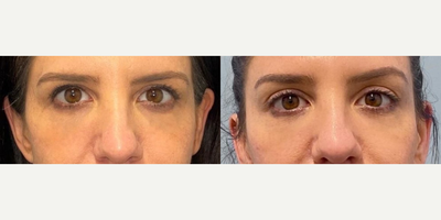 Woman treated with Sofwave - Photo provided courtesy of Sofwave, performed by Jason D. Bloom, MD