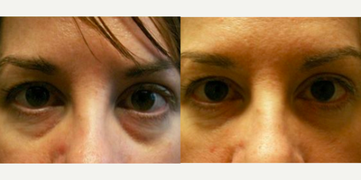 Woman treated with Restylane to tear troph - Restylane to tear troph