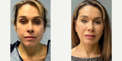 Woman treated with Facelift - Woman treated with Mini Deep Plane Facelift and Facial Fat Transfer