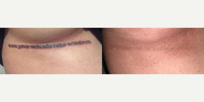 25-34 year old woman treated with Tattoo Removal - The first picture is shown immediately following the first session and the after is shown 4 weeks after the 8th session of PicoWay. To complete the tattoo removal and remove all remaining shading, the last session was done using the PicoWay Resolve handpiece.