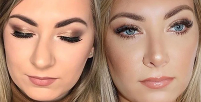 18-24 year old woman treated with Rhinoplasty - Open rhinoplasty
