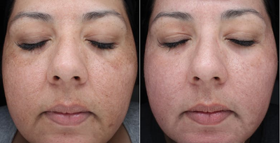 Woman in her 30's treated with Cosmelan - Woman in her 30's treated with Cosmelan, 2 weeks post-op
