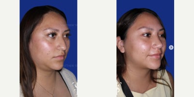 25-34 year old woman treated with Rhinoplasty, Chin Liposuction - 25-34 year old woman treated with Rhinoplasty, Chin Liposuction